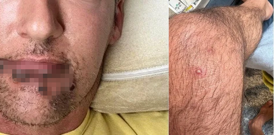 Actor de cine para adultos contrae viruela del mono y este es su testimonio