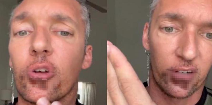 Actor de cine para adultos contrae viruela del mono y este es su testimonio