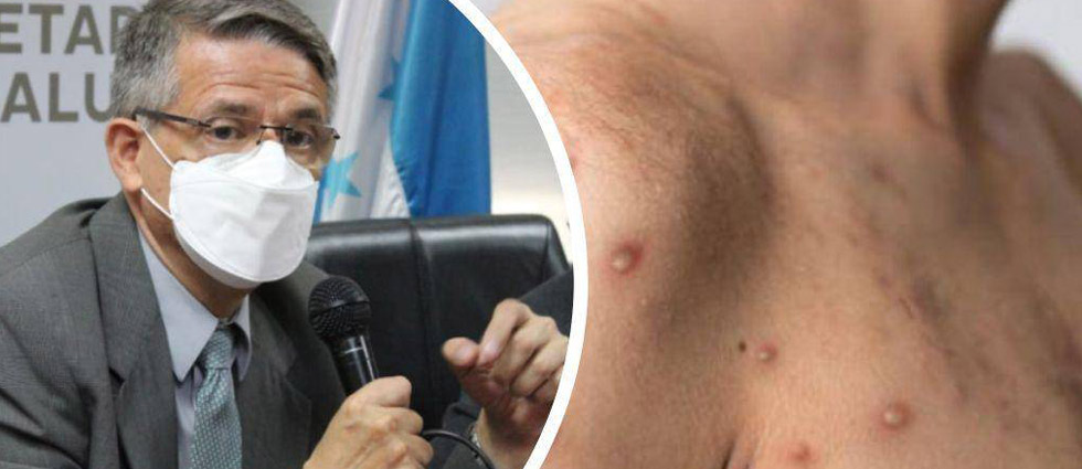 ¡La viruela símica llega a Honduras! Salud confima el primer caso