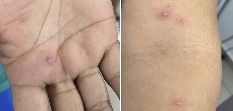 Estados Unidos reporta 24 mil casos de viruela del mono