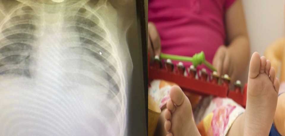 Niña de 2 años se traga una batería y le explota en el estómago