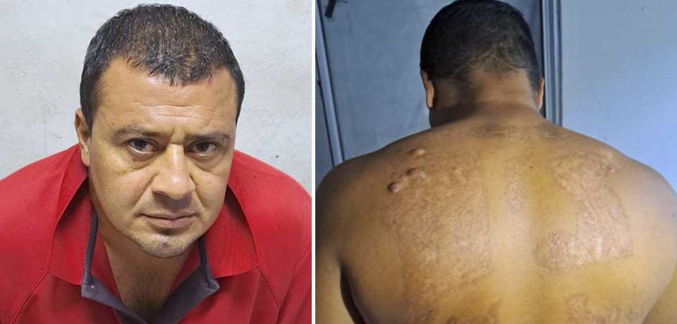 Cae pandillero que quemó por completo el MS que llevaba en la espalda