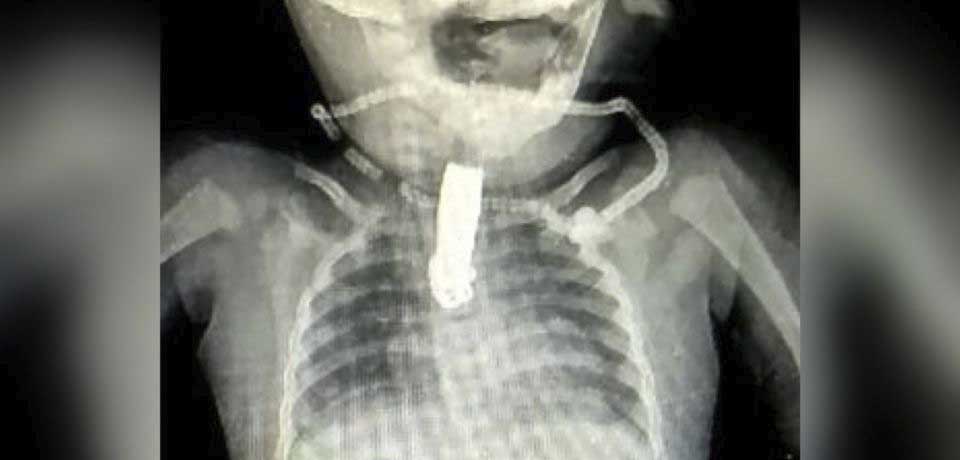 Bebé casi pierde la vida por tragarse un cortaúñas