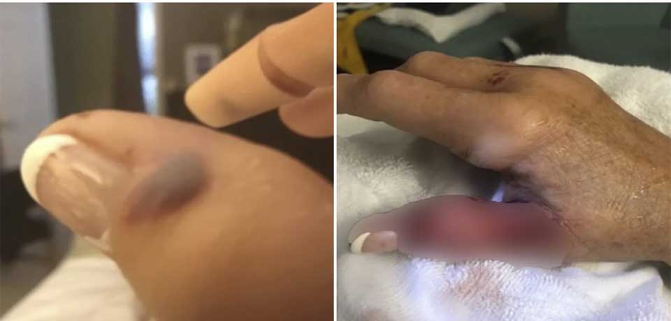 Se disparan los casos letales por bacteria «come carne» en Florida 