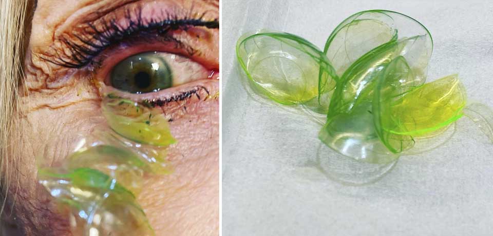 Remueven 23 lentes de contacto alojados en el ojo de una anciana 