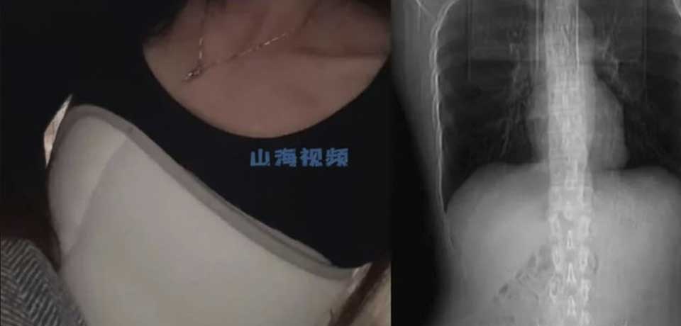 Mujer se quiebra cuatro costillas tras sufrir ataque de tos
