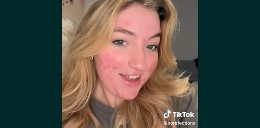 Suspenden cuenta a TikToker por mostrar su rostro con acné