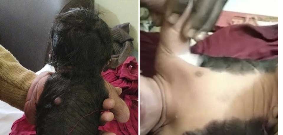 Bebé nace con toda su espalda cubierta de pelo