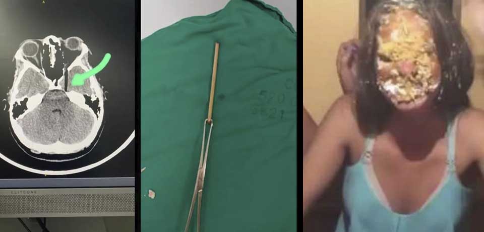 Cumpleañera pierde un ojo tras clavarse el palo insertado en el pastel