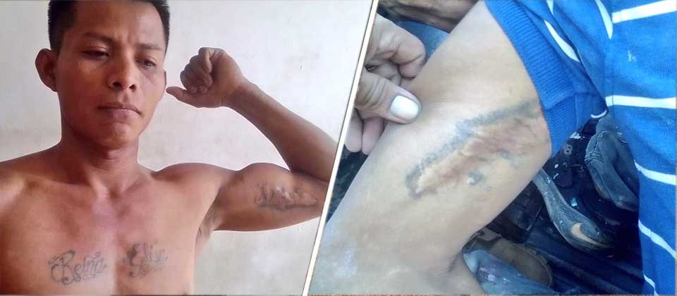 Detienen a gatillero de la 18 que se quemó sus tatuajes para no ser reconocido