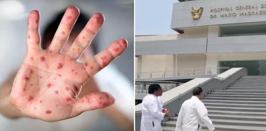 México reporta casi 4 mil casos de viruela símica y cuatro fallecidos a causa de la enfermedad