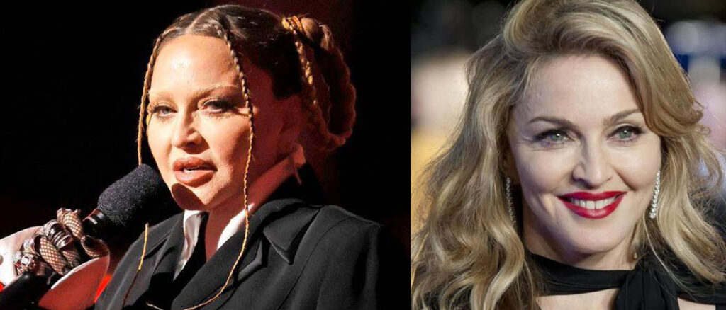 Madonna está ansiosa por recuperar su rostro natural antes de su próxima gira mundial &nbsp;