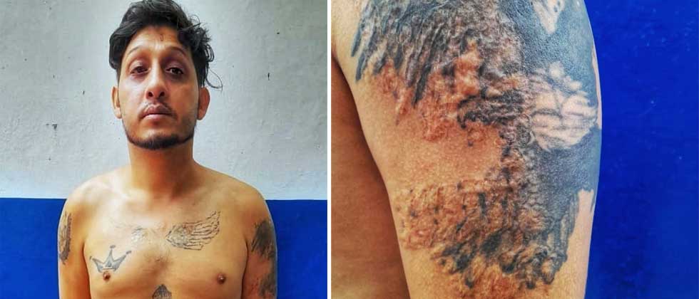 Pandillero vivirá con una horrible cicatriz al intentar quemar sus tatuajes de la 18
