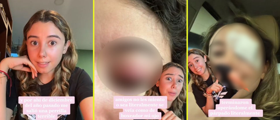 VIDEO: Jovencita casi pierde un ojo por hacer reto en TikTok