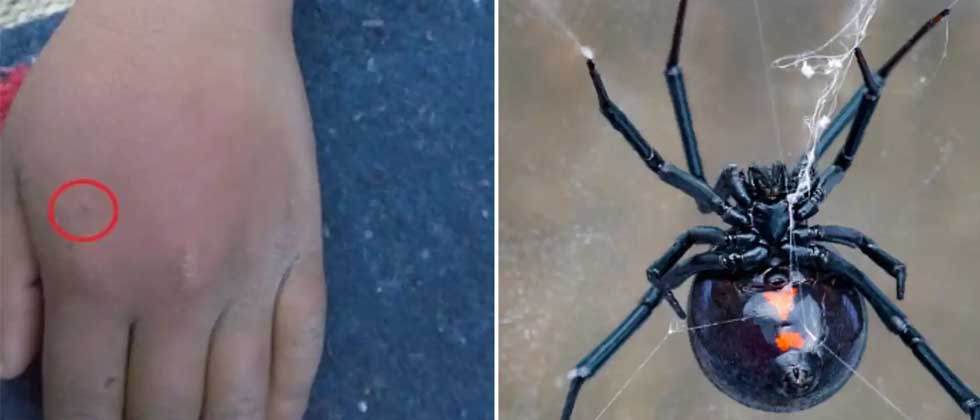 Niño se deja picar por viuda negra para convertirse en Spider-Man