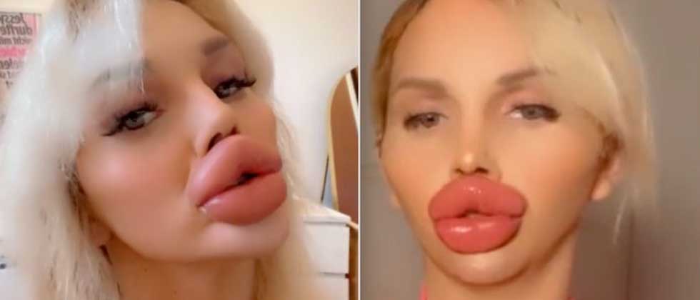Influencer con enormes labios confiesa que ya no puede comer ni beber bien