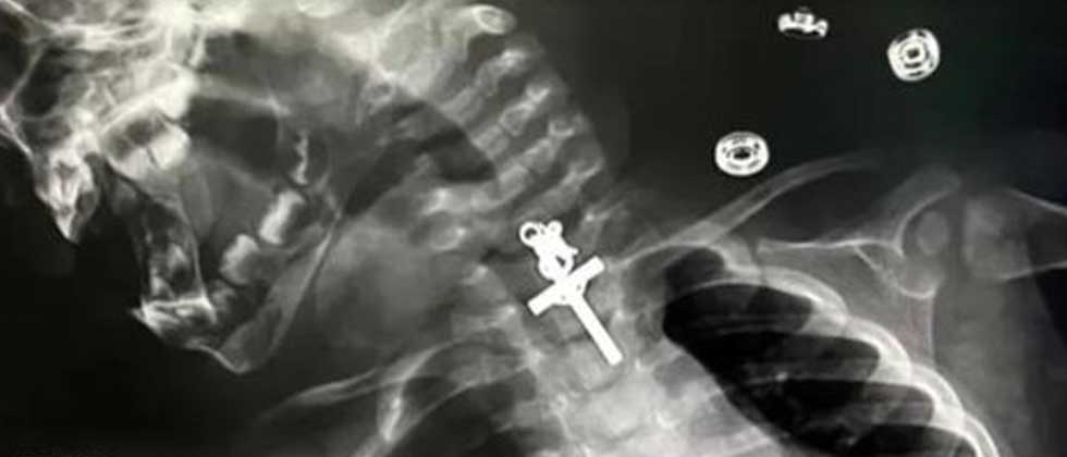 Bebé de 10 meses se traga crucifijo de metal y es operada de emergencia