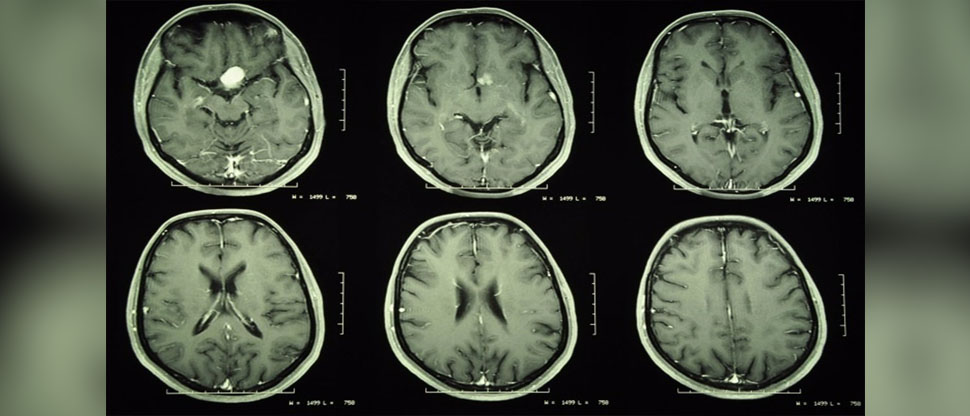 Uso de medicamentos con progesterona incrementa riesgo de padecer tumores cerebrales