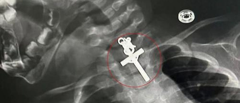 Extraen crucifijo de la garganta de un bebé de 10 meses