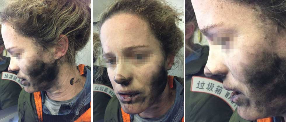 Joven sufre terribles quemaduras tras explotarle un audífono inalámbrico