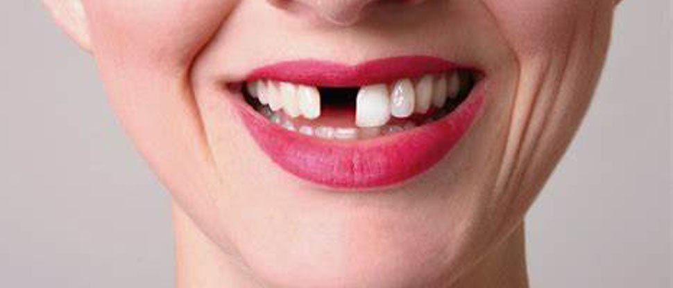 Ensayarán en humanos, fármaco para hacer crecer los dientes