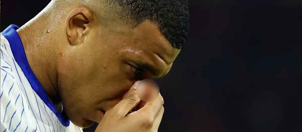 Así quedó la nariz Mbappé tras el juego de Francia contra Austria