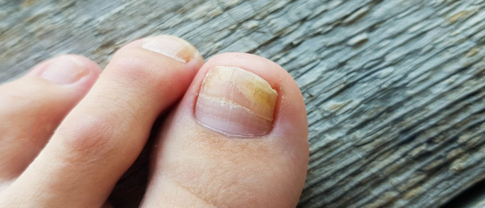 Estos son algunos consejos que ayudarían a evitar una uña encarnada