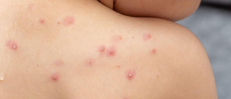 La OMS mantiene la alerta por la epidemia de mpox