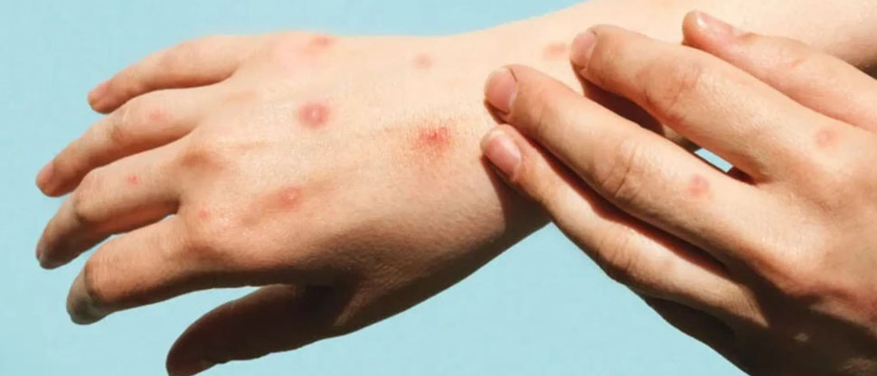 OMS: “Brotes de mpox en África podrían desaparecer en 6 meses”