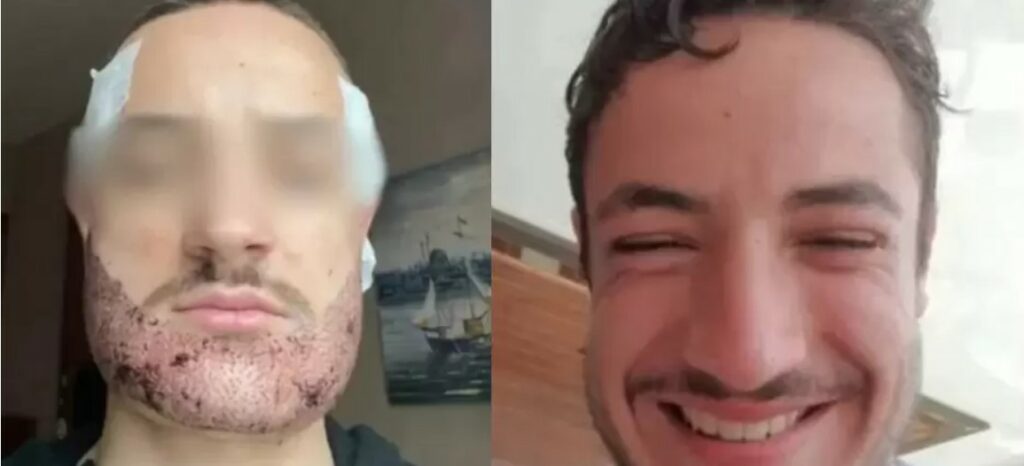 Joven se quita la vida tras fallido trasplante de barba hecho por un falso cirujano