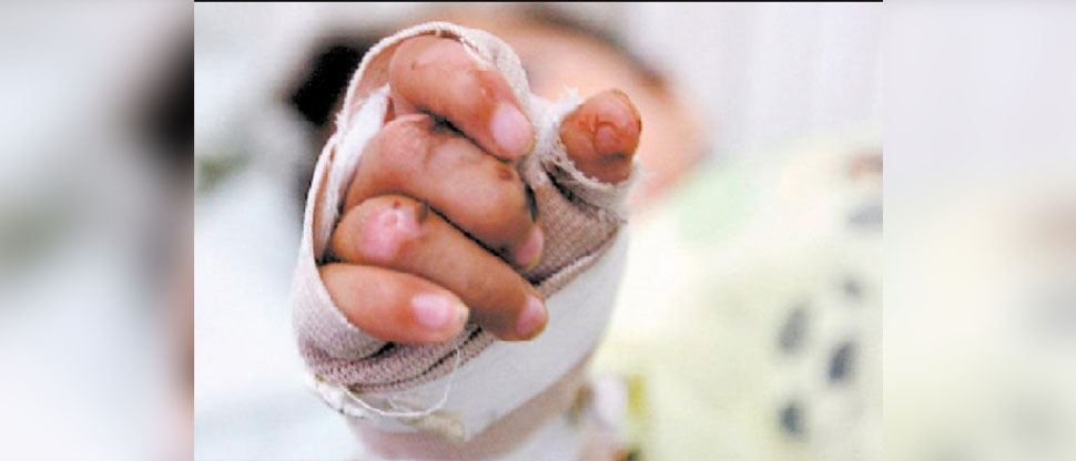 Reportan primer niño quemado con pólvora en Cabañas