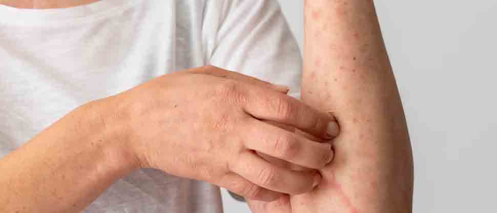 Cifra de casos de sarampión en Guatemala sube a 225