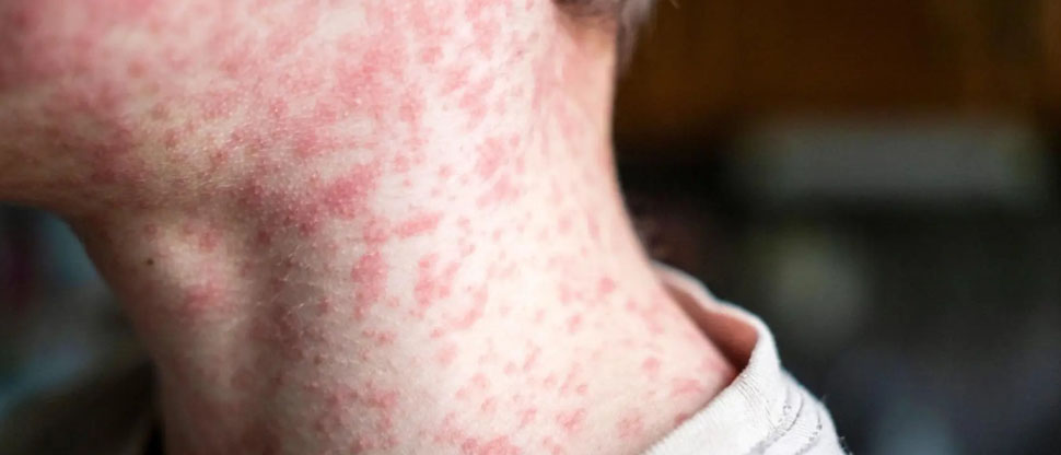 Honduras: en máxima alerta sanitaria por sarampión
