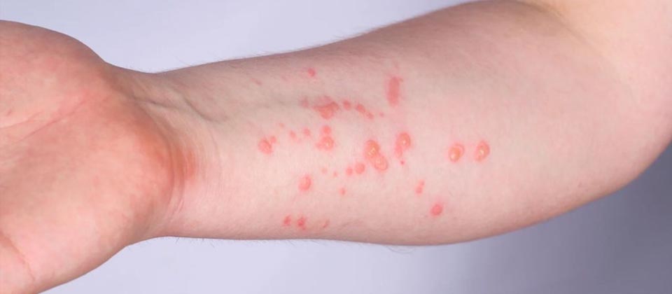 Japón confirma primer caso de variante de viruela símica