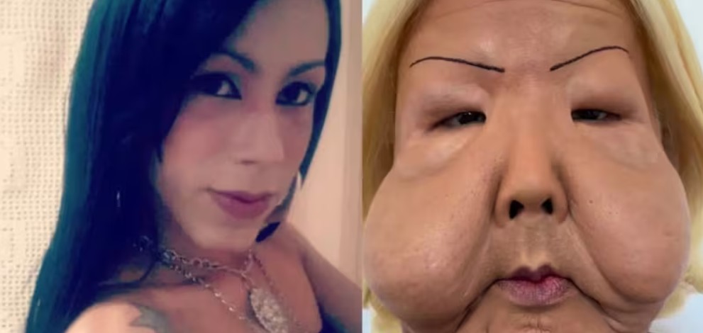 Influencer queda irreconocible tras recibir inyecciones de aceite y laxantes