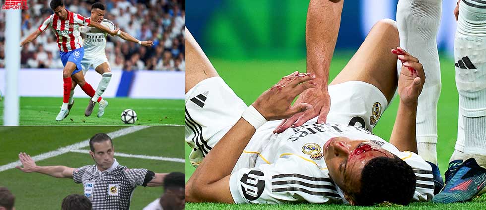 ¡Escándalo! Mbappé acaba con el rostro cortado tras un codazo en el área, pero para el árbitro no pasó nada