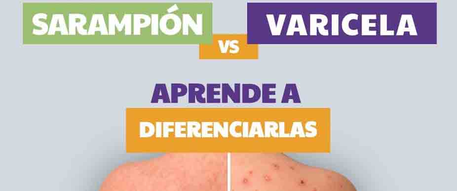 Lanzan consejos para diferenciar las enfermedades del sarampión y varicela